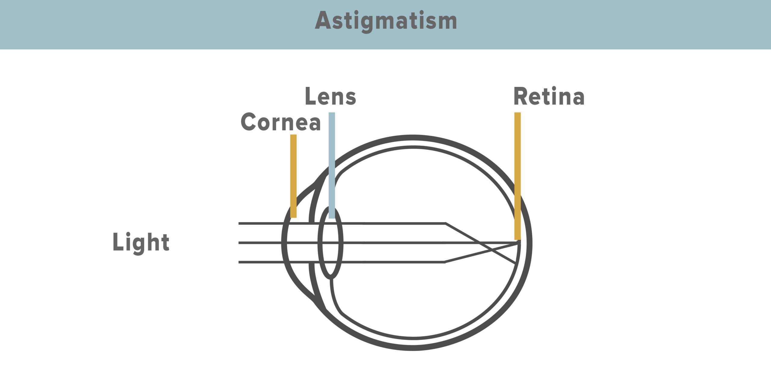 How an eye with astigmatism focuses improperly