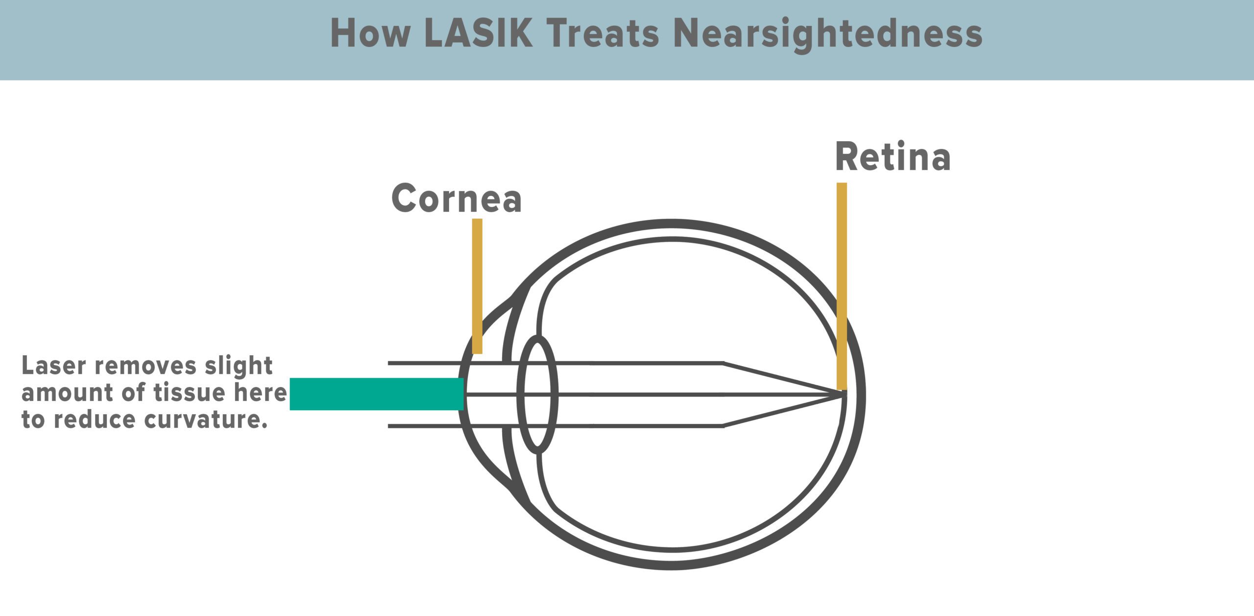 Diagram of how a LASIK procedure corrects myopia for Portland , Oregon patients. 